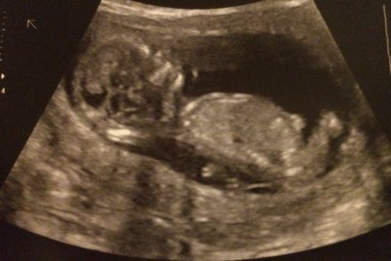 Ultrasound Gastroschisis